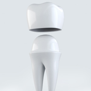 Dental Crowns